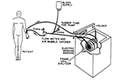 haemodialysis